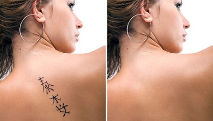 Способы удаления татуировки